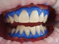 ¿Qué riesgos presenta el blaqueamiento dental?