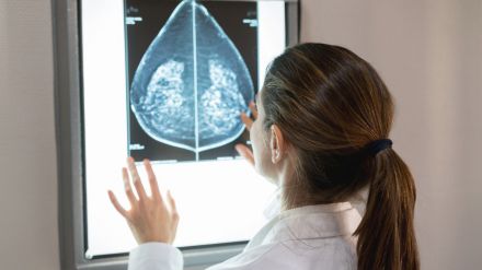 Científicos desarrollan innovador predictor de riesgo para pacientes con cáncer de mama