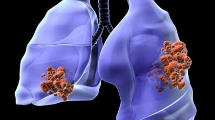 Descubierta una de las causas de resistencia a la inmunoterapia del cáncer de pulmón más frecuente
