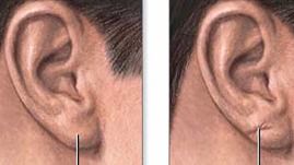 La presencia de un pliegue diagonal en el lóbulo de la oreja podría avisar del riesgo de ictus o infarto. ... l