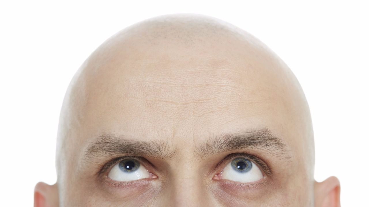 Hablamos de... Alopecia