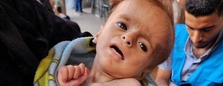 Crisis de desnutrición infantil en Gaza: más de 50 niños han muerto desde marzo
