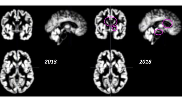 Logró rejuvenecer su cerebro 10 años tras superar la heroína y explica cómo hacerlo