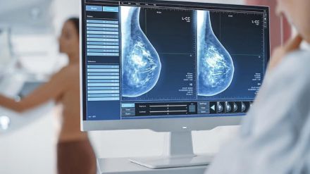 Un algoritmo permitiría predecir riesgo de cáncer de mamas a través de mamografías