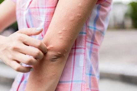 Consejos para prevenir y tratar picaduras de insectos y medusas en verano
