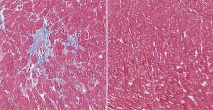 Avances en terapia génica con CRISPR para distrofia muscular rara