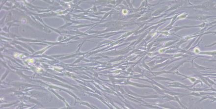 Investigadores descubren cómo un cáncer de hígado agresivo evade la quimioterapia