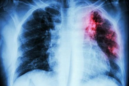 Nuevo método revela variantes genéticas desconocidas de la bacteria de la tuberculosis