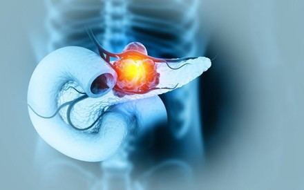 Nueva estrategia combina radioterapia y nanopartículas para tratar el cáncer de páncreas